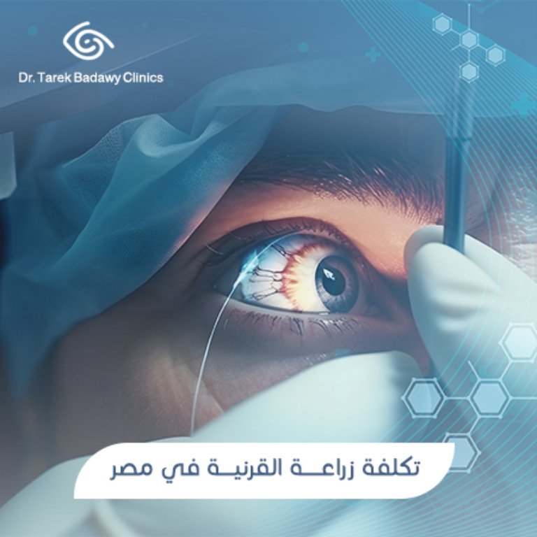 تكلفة زراعة القرنية في مصر